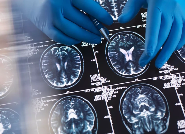 Physician examining brain MRI scans