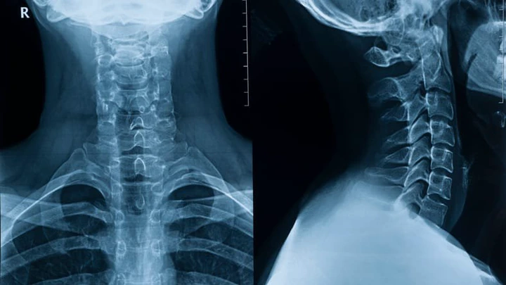 X-ray picture of the cervical spine of a man in two projections in full view and profile