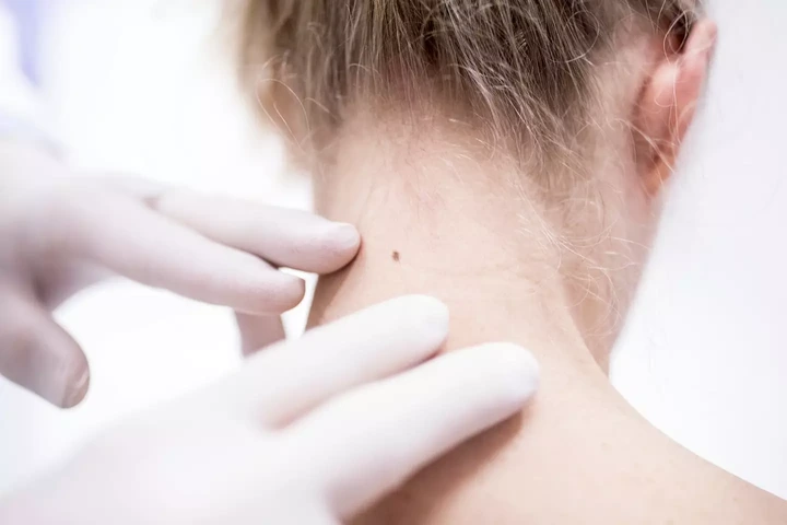 Many individuals will acquire moles on their skin throughout their lifetime, but distinguishing between a regular mole and melanoma can be challenging if you're unaware of the key indicators (Getty Stock Image).